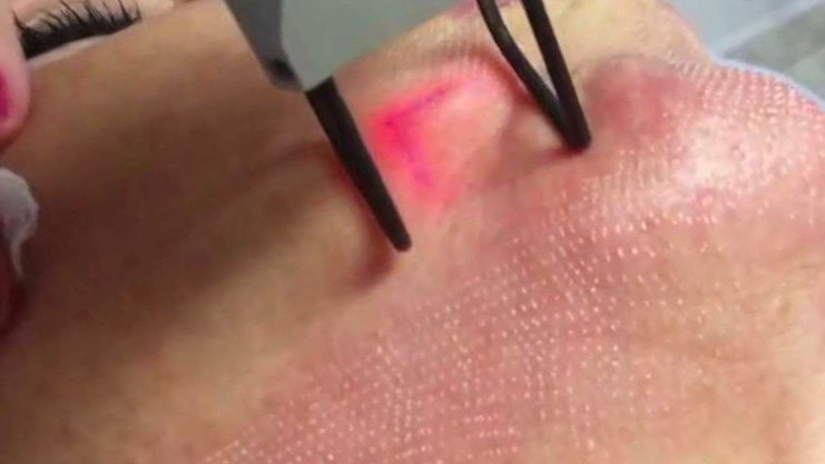 Laser treatment being applied to the cheek